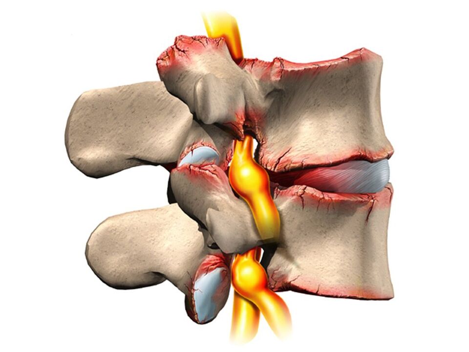 lesión espinal con osteocondrosis