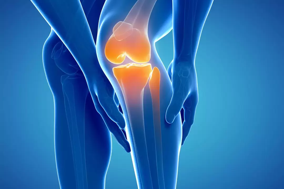 Artrosis de la articulación de la rodilla (gonartrosis, artrosis deformante)