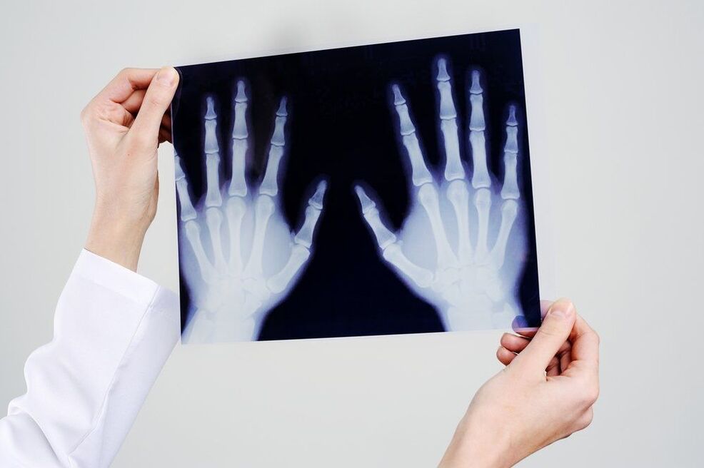 diagnóstico de la articulación de la mano