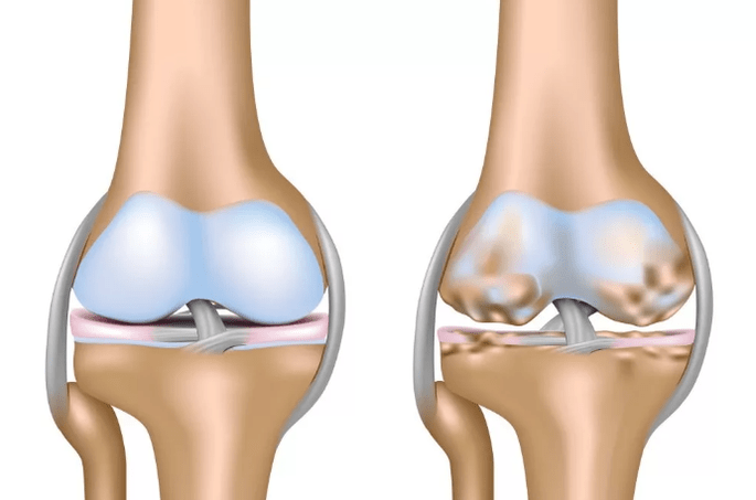 Deformar la artrosis de la articulación de la rodilla