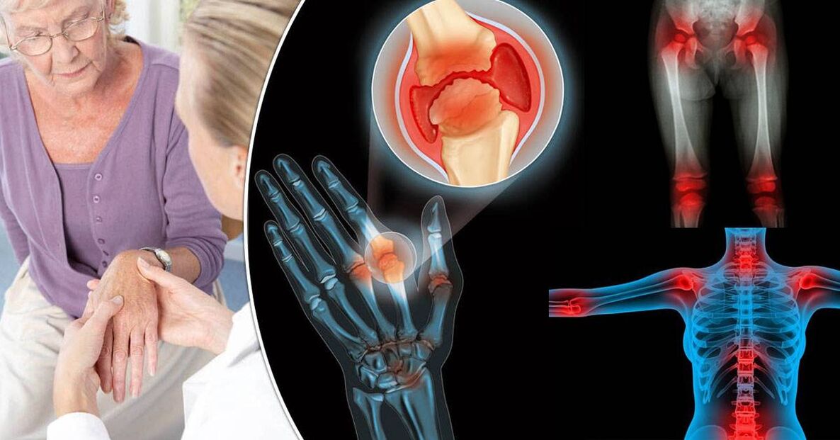 ¿Qué es la osteoartritis